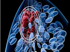 晚期乳腺癌患者使用帕博西尼效果怎么样？