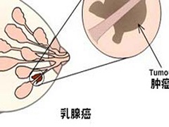 帕妥珠单抗的上市是乳腺癌治疗的又一进步