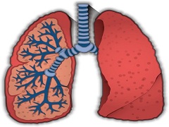 布加替尼与克唑替尼在非小细胞肺癌中的对比