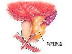 恩杂鲁胺对前列腺癌耐药的分子机制