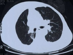 曲美替尼联合达拉菲尼可以有效控制肺癌