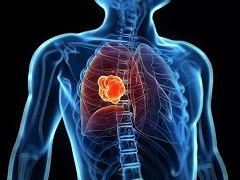 靶向药物尼达尼布能够为非小细胞肺癌提供治疗
