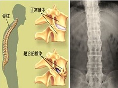 苏金单抗对于慢性炎症疾病的治疗