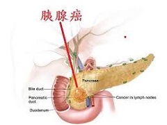 依鲁替尼治疗胰腺癌失败后患者该怎么办？