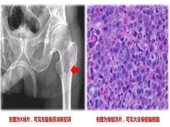 达雷木单抗是否有益于不能够移植的骨髓瘤患者？