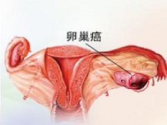 尼拉帕尼能夠改善BRCA突变的患者的PFS
