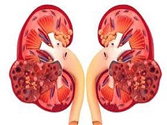 FDA批准卡博替尼前线治疗高级RCC