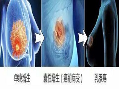 中晚期乳腺癌使用帕博西尼效果好