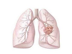 布加替尼治疗艾乐替尼下的难治性alk阳性NSCLC