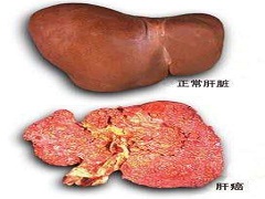 瑞戈非尼治疗标准化治疗的转移性结直肠癌