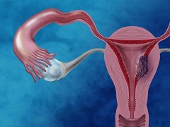 奥拉帕尼治疗铂类敏感性复发性卵巢癌
