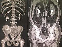 哪些情况下需要进行阿西替尼剂量调整