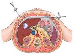 吉三代治疗失代偿期肝硬化患者的HCV