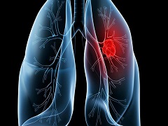 布加替尼与其他药物治疗非小肺癌的疗效比较