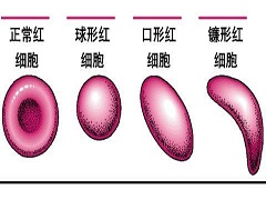 芦可替尼能大幅延长患者生存期