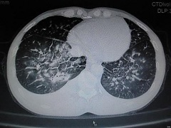 艾乐替尼能够有效缓解三期肺癌患者病情