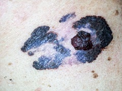 如何预防黑色素瘤类的皮肤癌？