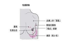 三期乳腺癌患者可以使用帕博西尼进行治疗