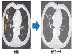 克唑替尼耐药后能继续使用色瑞替尼治疗吗？