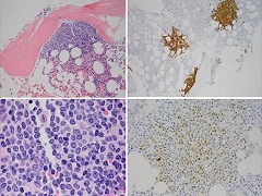 Acalabrutinib可以治疗套细胞淋巴瘤等疾病
