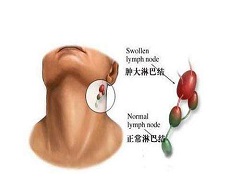 长期使用acalabrutinib可能会发生哪些不良反应？