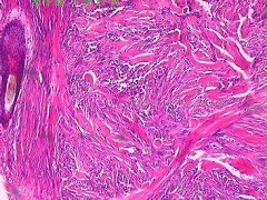 隆突性皮肤纤维肉瘤容易复发和转移