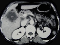 腹膜癌治疗手段不再局限