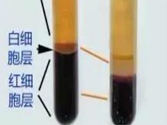 使用达克替尼治疗晚期或转移性阴茎鳞状细胞癌