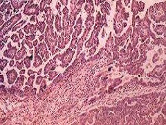 2018 NCCN卵巢癌包括输卵管癌及原发性腹膜癌临床实践指南
