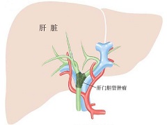 曲美替尼可以联合治疗胆管癌