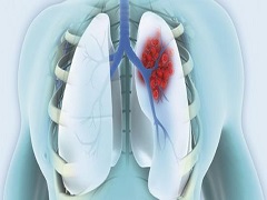 艾乐替尼创造了肺癌领域治疗的记录