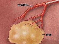 关于乐伐替尼的定量分析