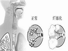 尼达尼布的功效及副作用