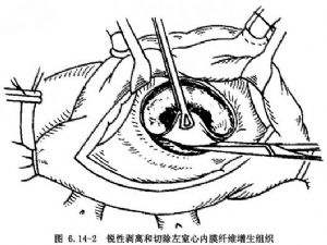 二尖瓣修复术