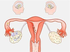 女性发病率较高的卵巢癌，你知道多少？
