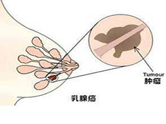 乳腺癌手术后会容易复发吗？