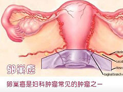 海得康海外就医告诉你卵巢癌怎么预防