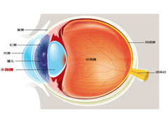 海得康治疗疾病：白内障