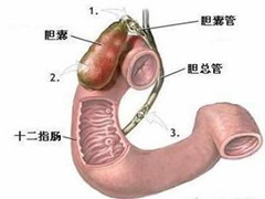 胆囊炎是什么该如何治疗？