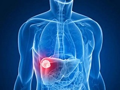 肝癌是什么有哪些治疗方式