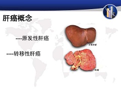 肝癌介绍及治疗方法详解