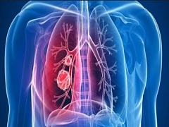 肺癌晚期患者赴美挽救生命