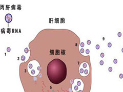  海得康海外就医丙肝患者治疗实纪