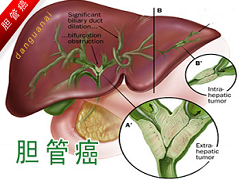 胆管癌出现发烧后的生存期问题