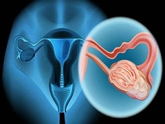 宫颈癌的早期症状有哪些？