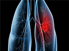 肺癌新发现：新的肺癌生物标志物