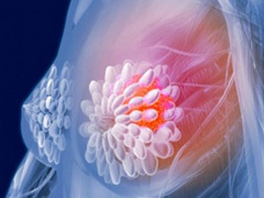 恶性乳腺癌的时间变化
